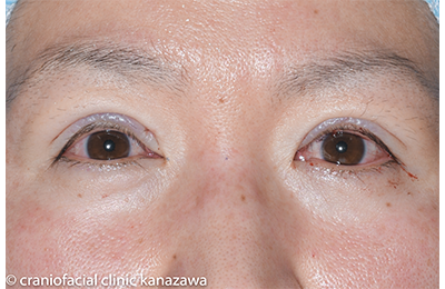 目 の 腫れ アレルギー 目の周りの赤い腫れはアレルギー?意外に多いまぶたの赤みの病気一覧！