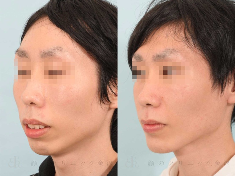 骨切り術 横顔の変化 コラム 顔のクリニック金沢 金沢の美容外科 形成外科