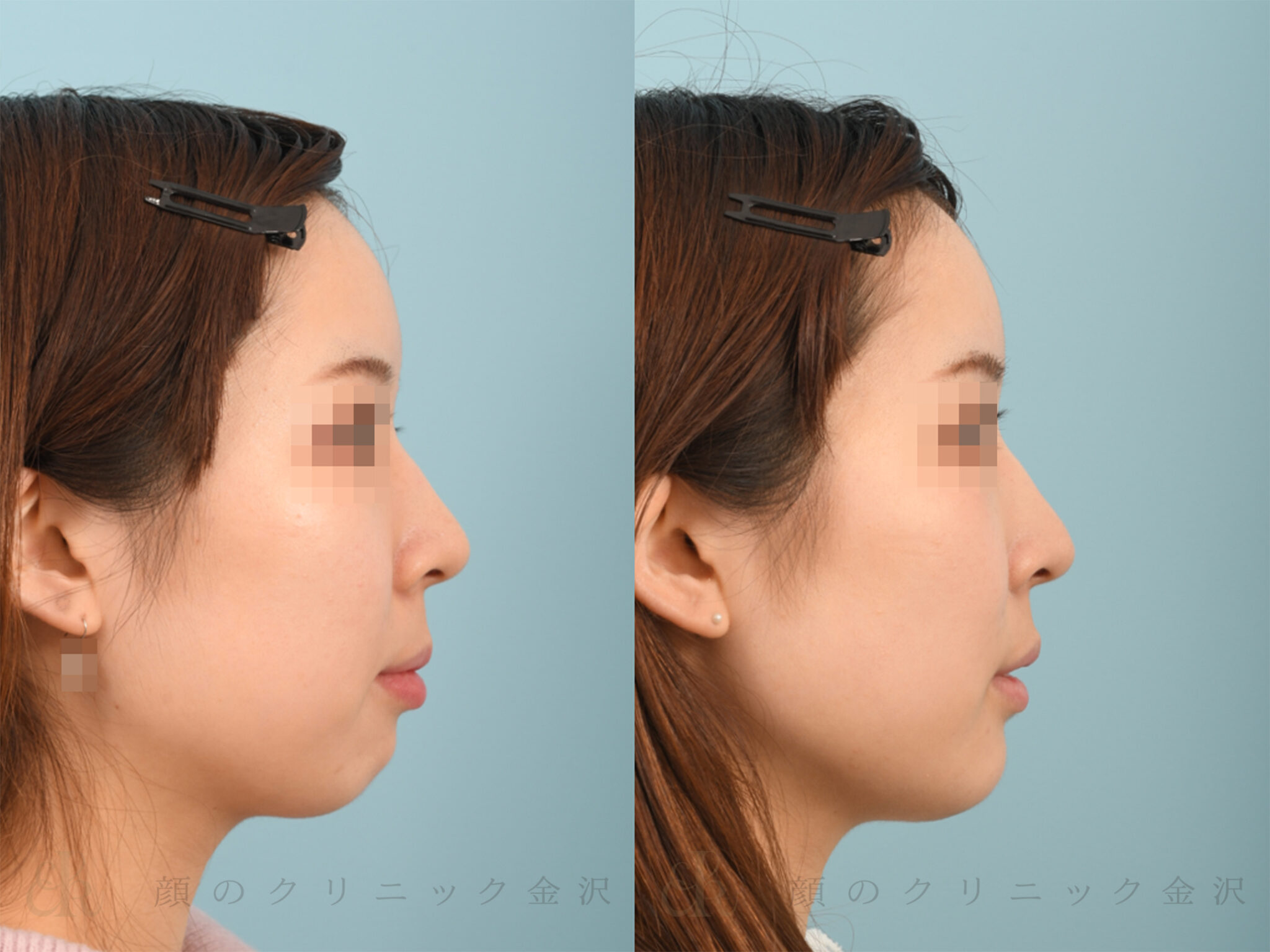 オトガイ形成術の種類